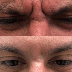 botox-on-the-11s-male