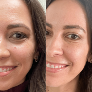 botox-on-the-forehead-female