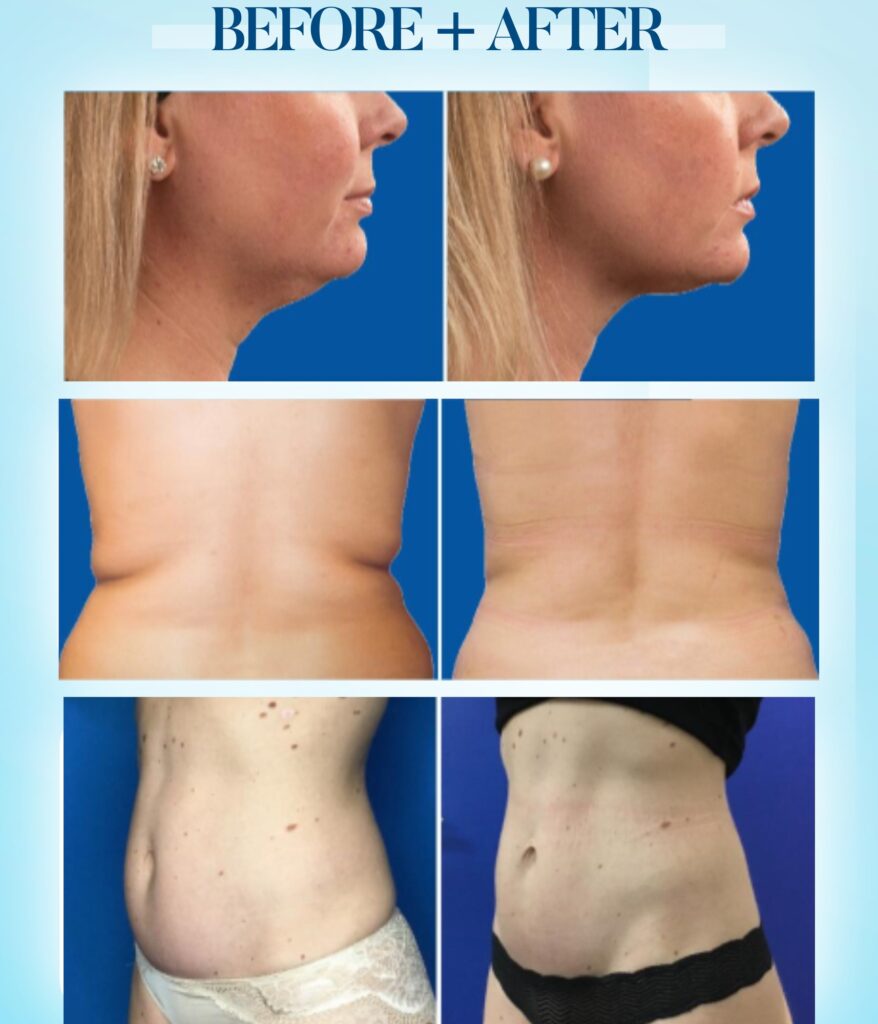 Body Contouring