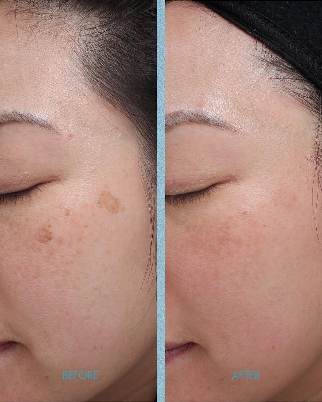 LASE treatment, before and after 02